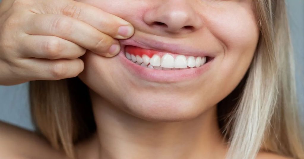 Diş Eti Hastalıkları